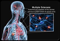 Chứng đa xơ cứng-Multiple Schlerosis