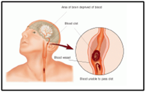 Bệnh nhân bị đột quỵ có thể đi lại được sau khi được cấy tế bào gốc trực tiếp vào não bộ.