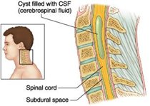 Bệnh Rỗng Tủy sống / Cứng cột sống / Syringomyelia / Tethered Cord