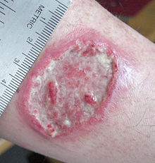 220px-Leishmaniasis_ulcer.jpg