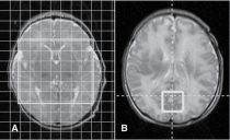 Kỹ thuật NMRI hay MRI